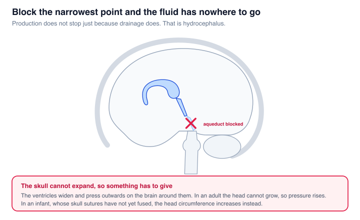 An animation showing the cerebral aqueduct blocked. The lateral ventricle progressively enlarges because production continues while drainage has stopped, which is hydrocephalus