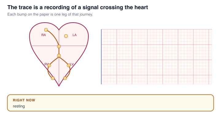 An animation of the electrical signal crossing the heart, synchronised with the trace being drawn. The SA node fires and the atria depolarise, producing the P wave. The signal is held at the AV node, producing the flat PR segment. It then travels down the bundle of His and the bundle branches into the ventricles, producing the QRS complex, and finally the ventricles repolarise, producing the T wave